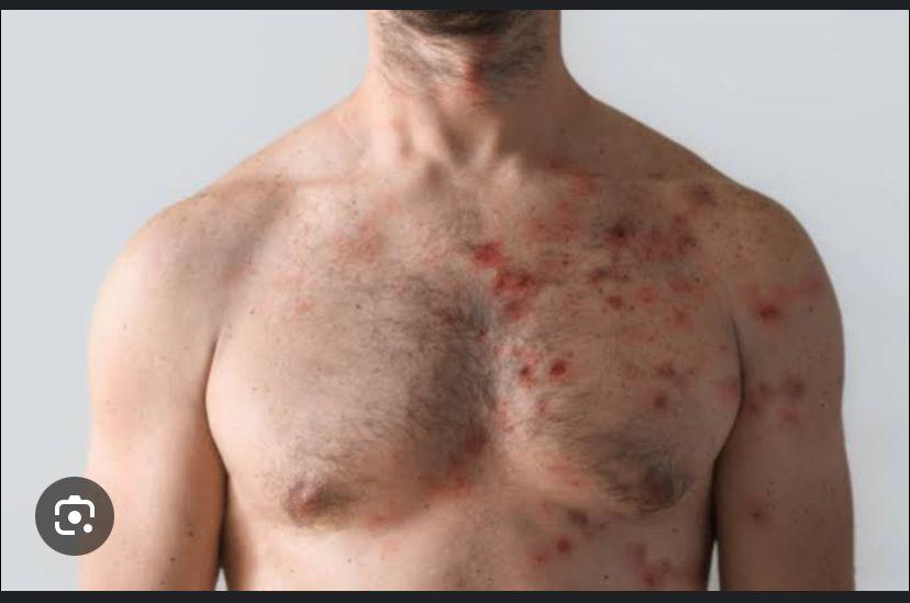 Ilhéus diagnostica caso de Mpox e garante assistência rápida, segura e eficiente